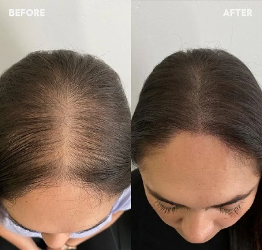 PRP Hair Treatment in Dubai: Transform Your Hair and Confidence