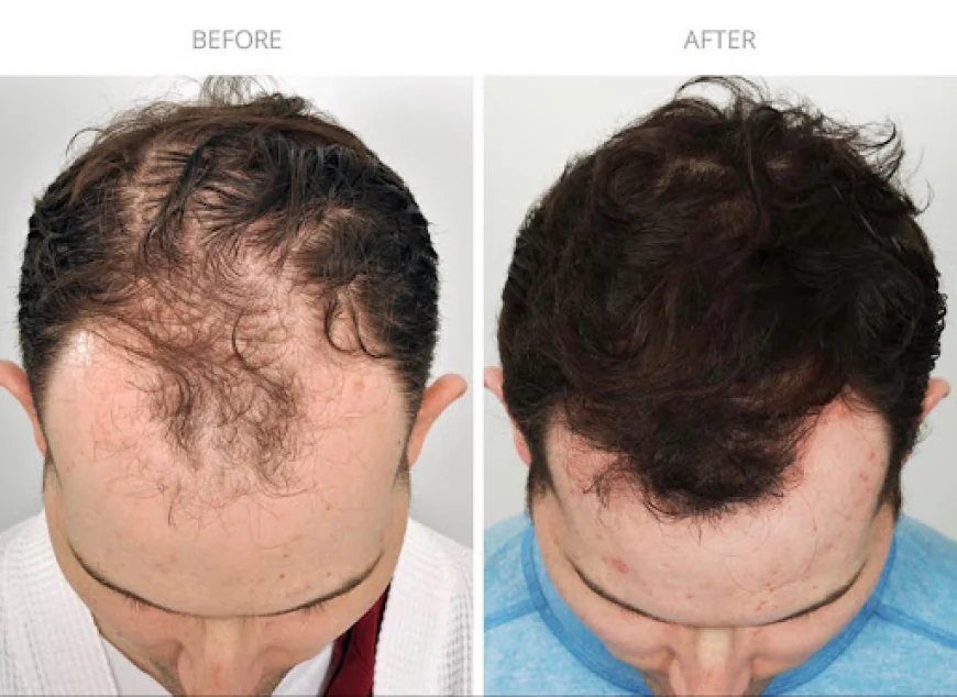 The Ultimate Guide to Sapphire FUE Hair Restoration: Results You Can Trust