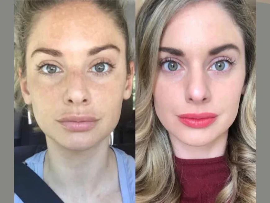 Best Plastic Surgeon in dubai for Advanced RF Microneedling