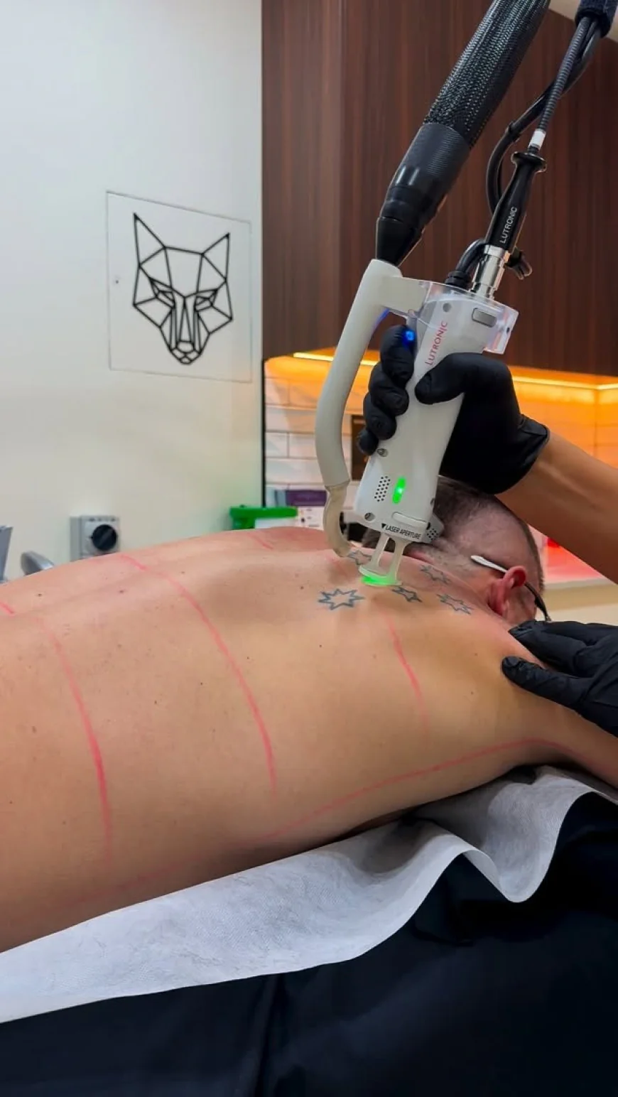 Hair Removal For Men Bondi Junction: Benefits Explained