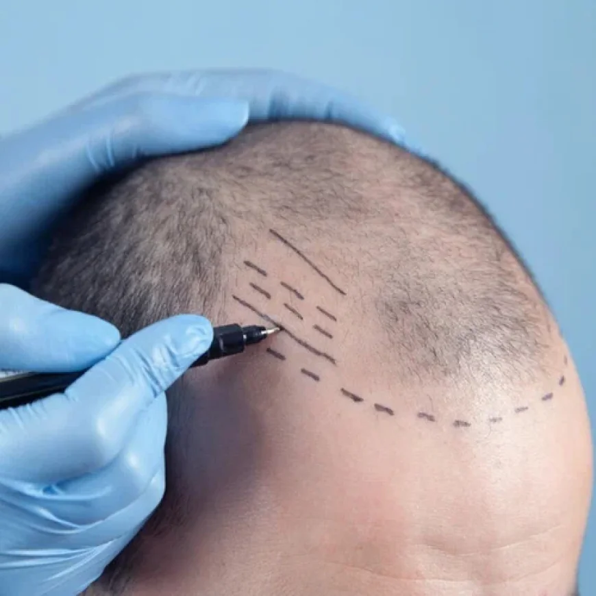 Hair Transplant in Islamabad – Cost, Procedure & Results Guide