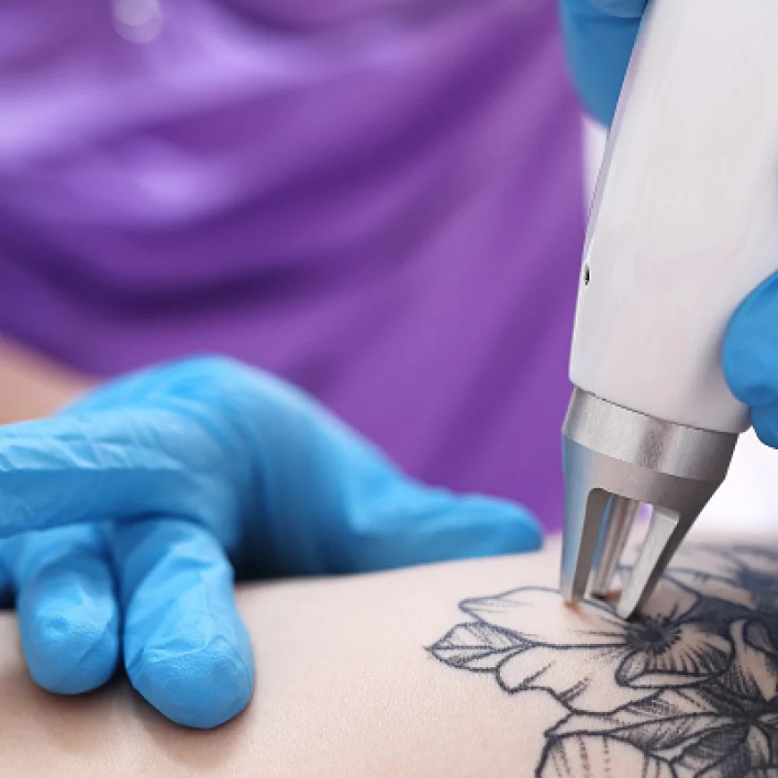 Tattoo Removal in Dubai: Cost Guide and Pricing Factors