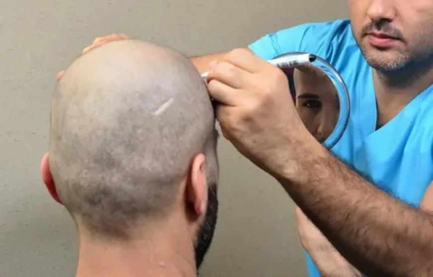 نصائح مهمة بعد إجراء عملية زراعة الشعر لتحقيق الشفاء السريع