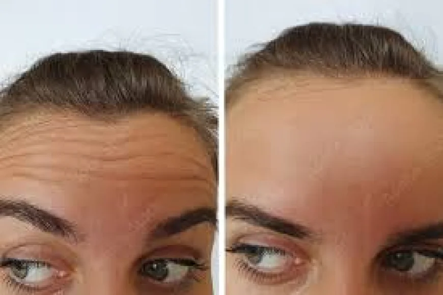 How Younger Generations Are Changing Botox and Beauty Standards in 2026