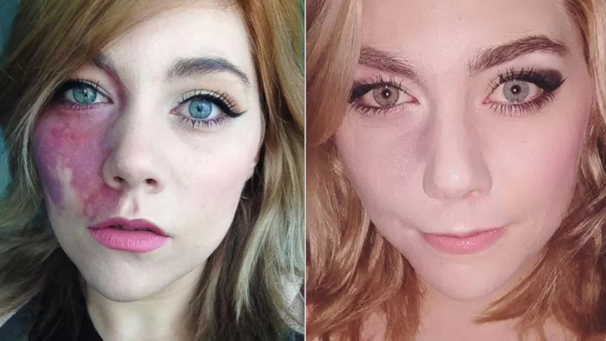 Birthmark removal in Riyadh for large or deep birthmarks