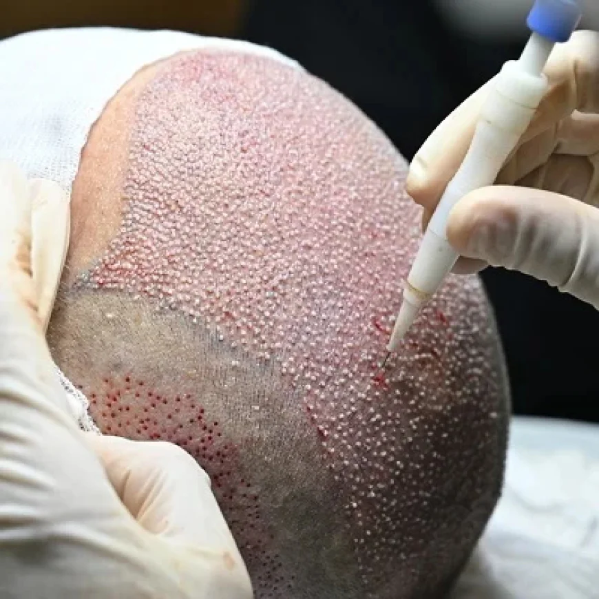 Non-Surgical vs Best Hair Transplant in Islamabad: Which Works Better?