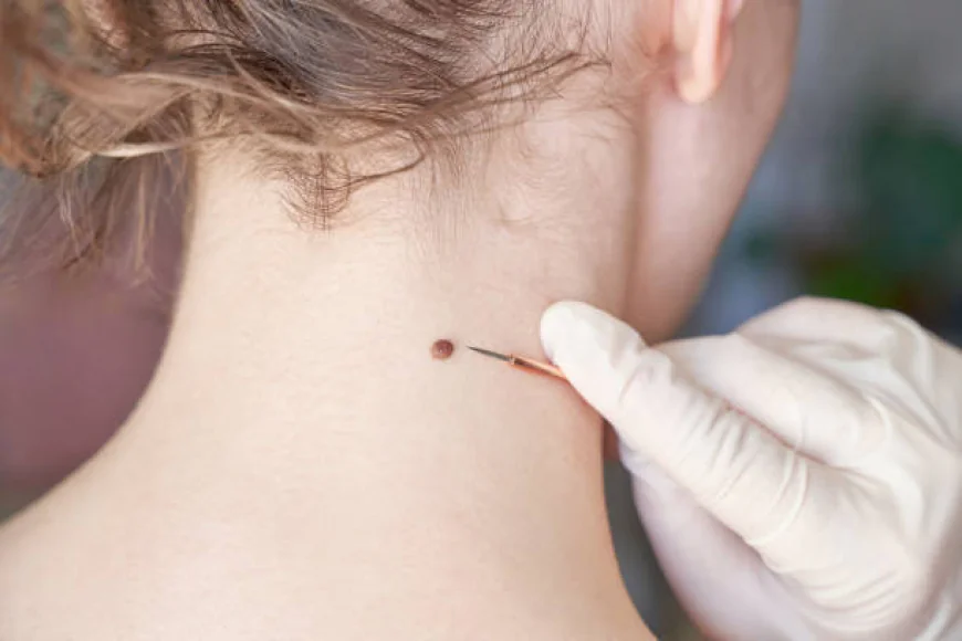 Precision Skin Tag Removal in Dubai for Lasting Smoothness