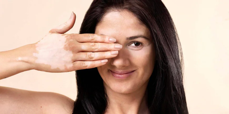 Best Vitiligo Cream & Vitiligo Home Remedy