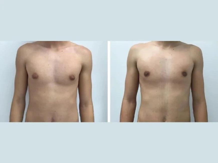 Top Choice for Men: Best Gynecomastia Surgeond in dubai