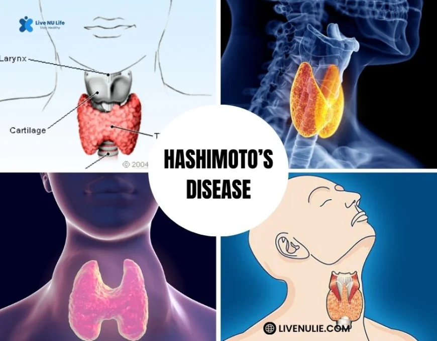 Hashimoto’s Disease
