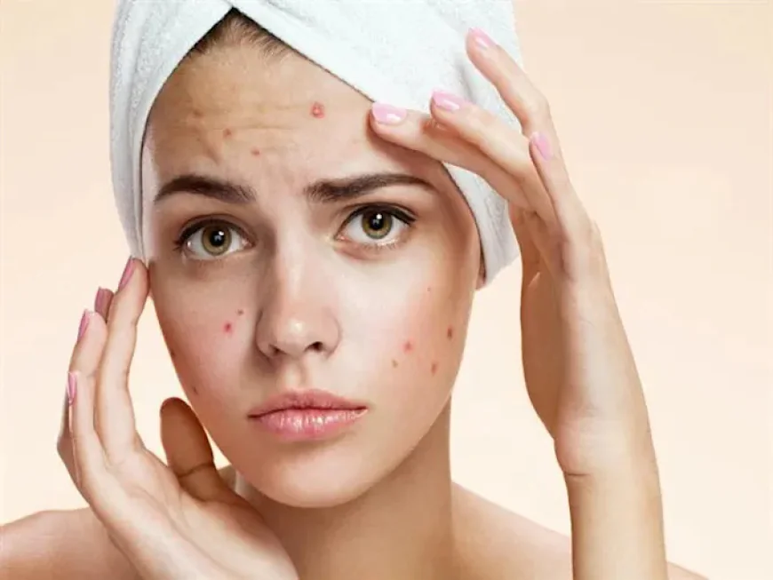 Use of chemical peels for pimples treatment in Riyadh