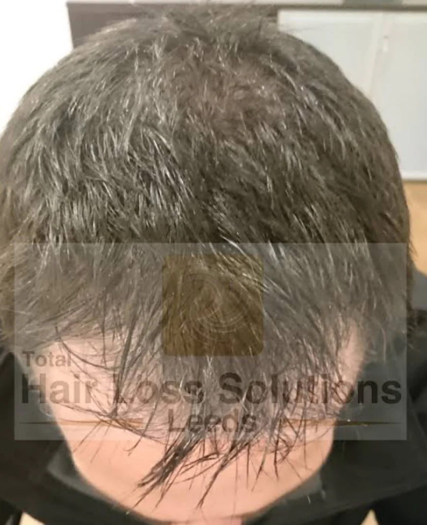 Best Hair transplants in Yorkshire
