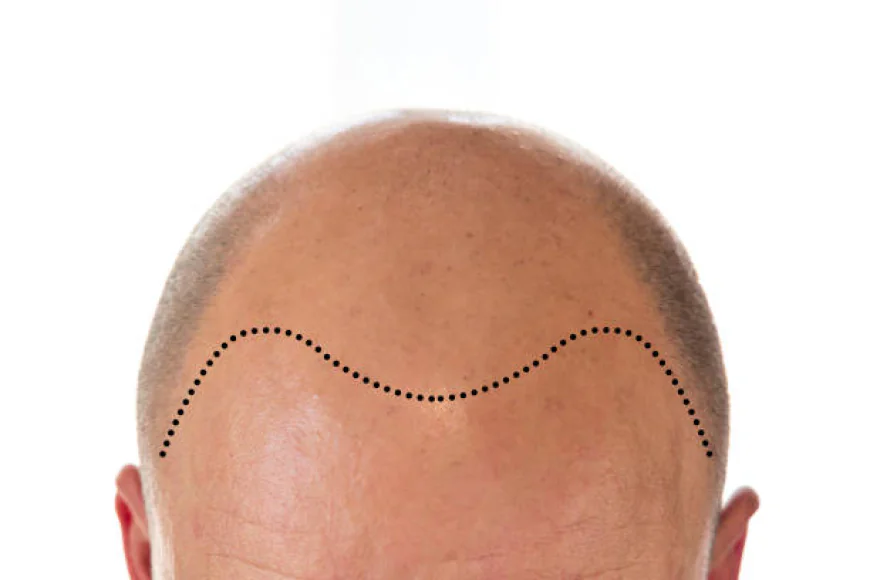 How Technology Is Changing Hair Transplant Results
