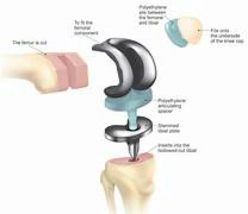 Top best knee replacement surgeon in chennai