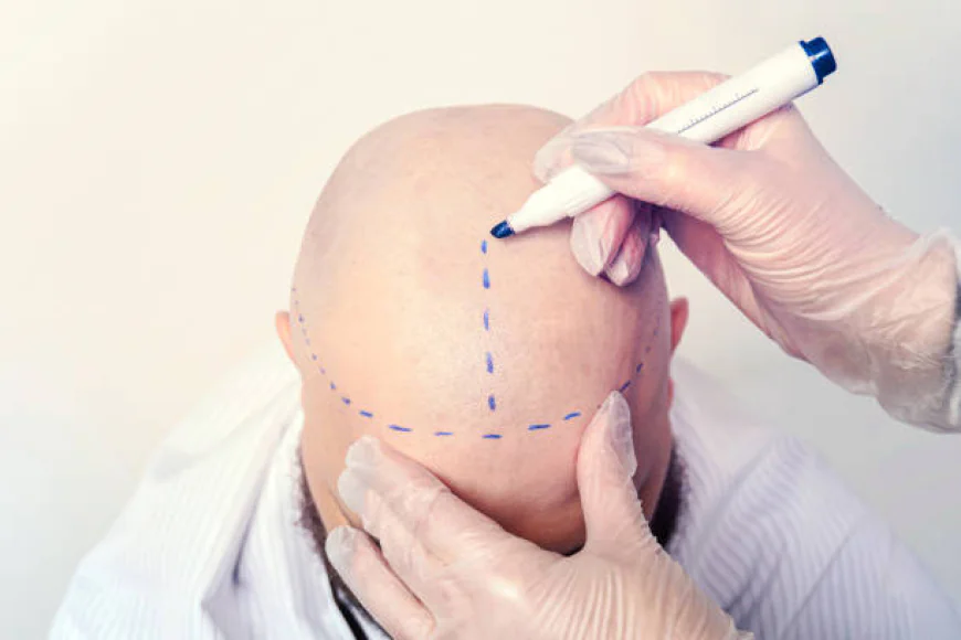 Future of Hair Transplant Technology