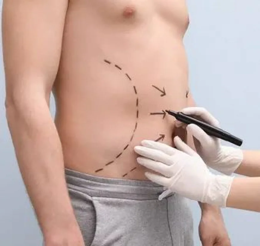Lipoabdominoplasty to Achieve a More Defined Waistline
