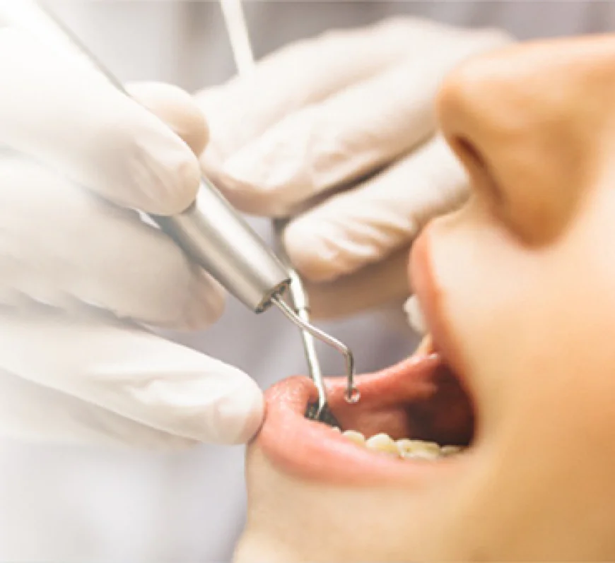 Step-by-Step Guide to Laser Root Canal Treatment and Its Advantages