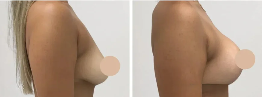 Advanced Techniques for Breast Lift in Dubai