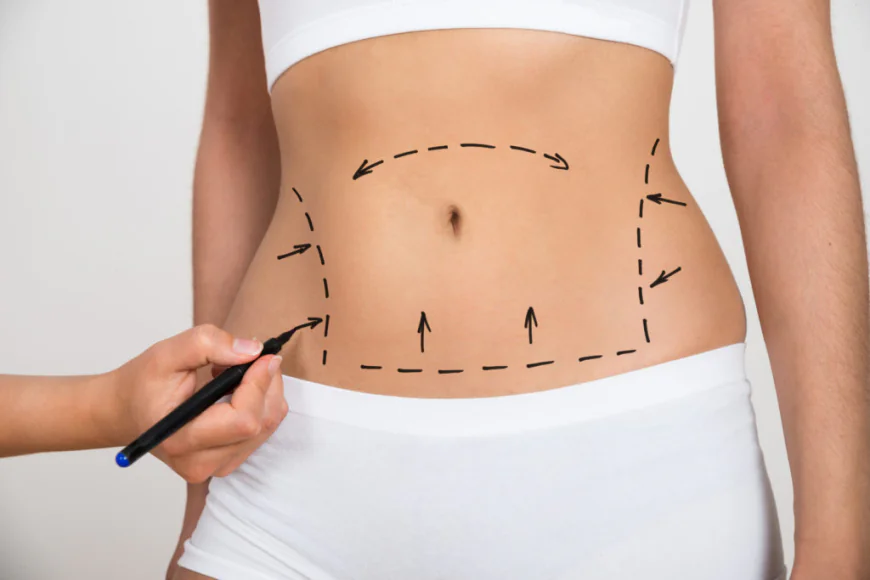 Best Liposuction Surgeon in Dubai Explain How to Prepare for Surgery