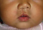 Cleft Lip Surgery in Islamabad: Step-by-Step Procedure Explained
