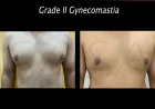 Gynecomastia Surgery in Delhi: Expert Care & Results
