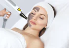 Q-Switched Laser Mastery: Conquering Common Skin Discolorations