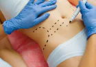 Fat Melting Injection vs. Liposuction: Which Is Right for You in Islamabad?