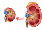What is the fastest way to get rid of kidney stones?