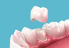 Why Are Dental Crowns in San Jose an Important Part of Complete Dental Care?