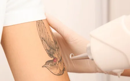 Rethink Your Ink: The Ultimate Guide to Laser Tattoo Removal in Islamabad
