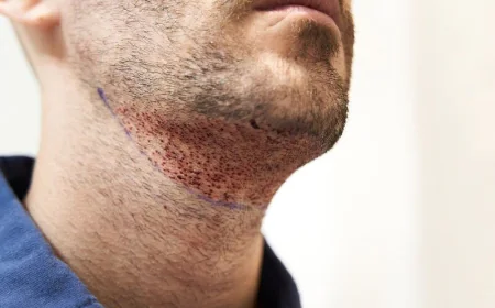 Beard Hair Transplant to Achieve a Fuller, Well-Shaped Beard