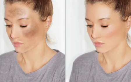 Birthmark Removal in Dubai: Before & After Photos
