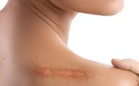 How Are Hypertrophic Scars Different from Keloid Scars?