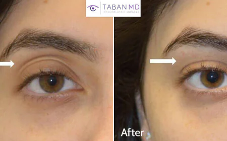 How to Fix Sunken Eyes With Fillers: The Ultimate Solution for a Refreshed Look