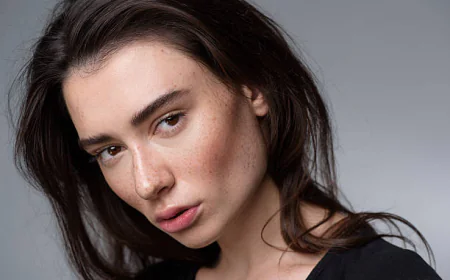 Customized Melasma Treatment Approaches