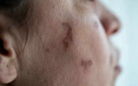 Birthmark Removal in Dubai: Laser Therapy for Face and Body Explained