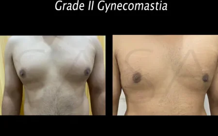 Gynecomastia Surgery in Delhi: Expert Care & Results