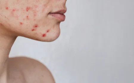 Microneedling for Acne Scars in Dubai: Restore Your Skin Naturally