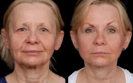 Best Aesthetic Clinic in Dubai on Treating Under Eye Fillers Hollows Naturally