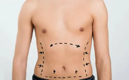 Liposuction in Dubai: The Ultimate Guide to High-Definition Body Sculpting