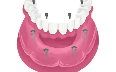 How the Best Orthodontist Supports Implant Dentist in Houston?