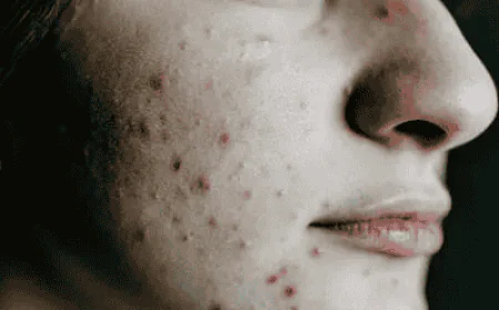 Acne Treatment Ingredients That Beginners Should Know