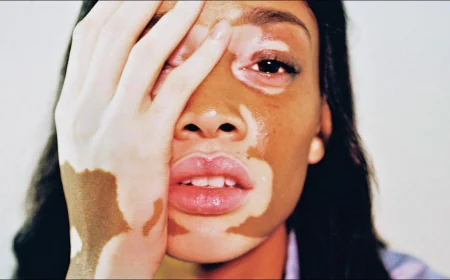 Best Vitiligo Treatment in Islamabad – Causes, Symptoms & Solutions