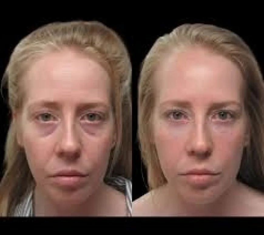 Best Plastic Surgeons in Dubai for Safe and Natural Under Eye Fillers