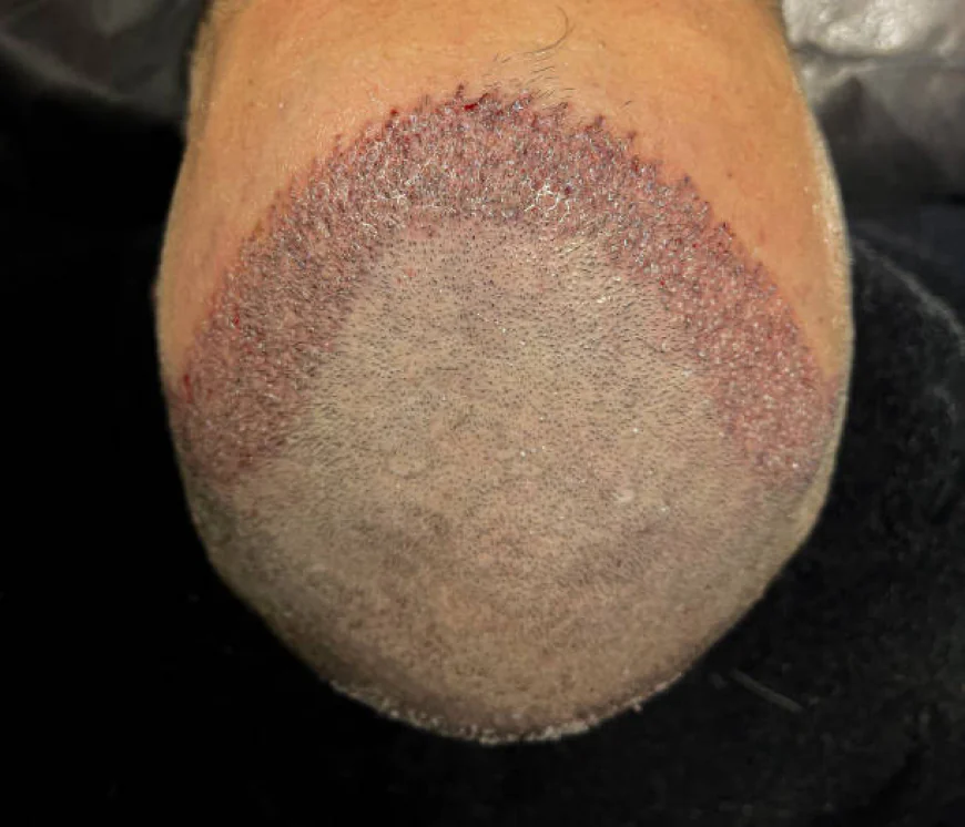 Minimizing Scars in Hair Transplant