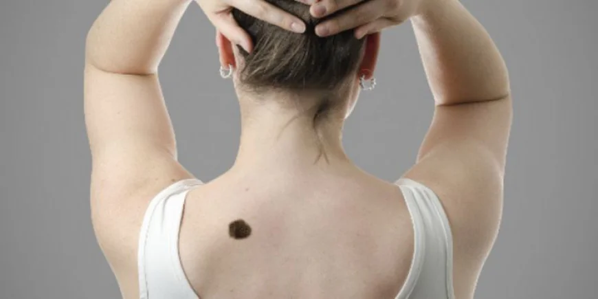 Birthmark Removal in Dubai: Maintain Professional Aesthetics with Clear Skin