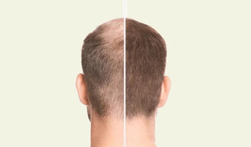 Crown Hair Transplant: Long-Term Results Dubai