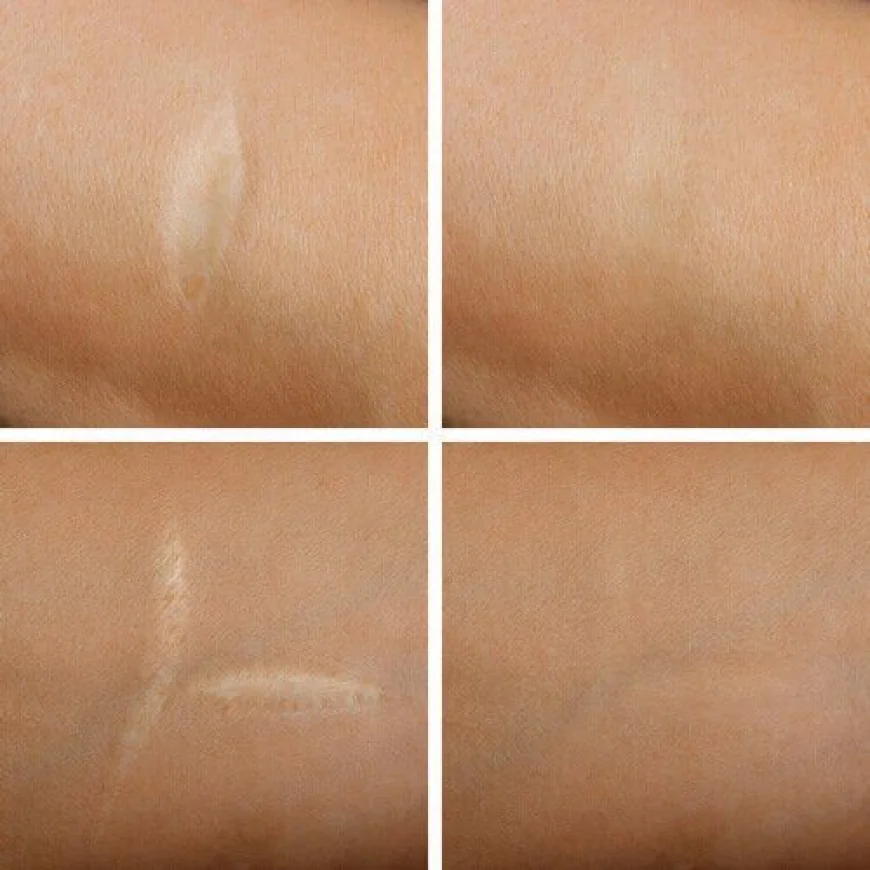 Royal Clinic’s Trusted Laser Scar Removal Treatments