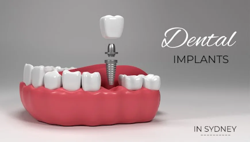 Comparing Dental Implant Costs Across Sydney Practices