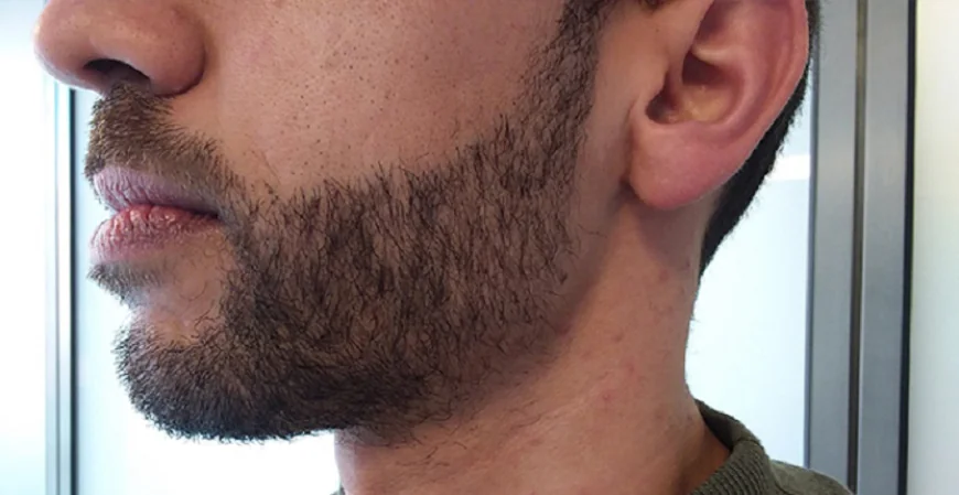 Beard Hair Transplant Dubai: Facial Hair Restoration Guide